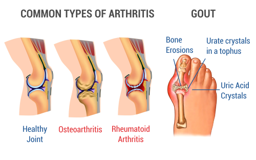 common types of arthiritis