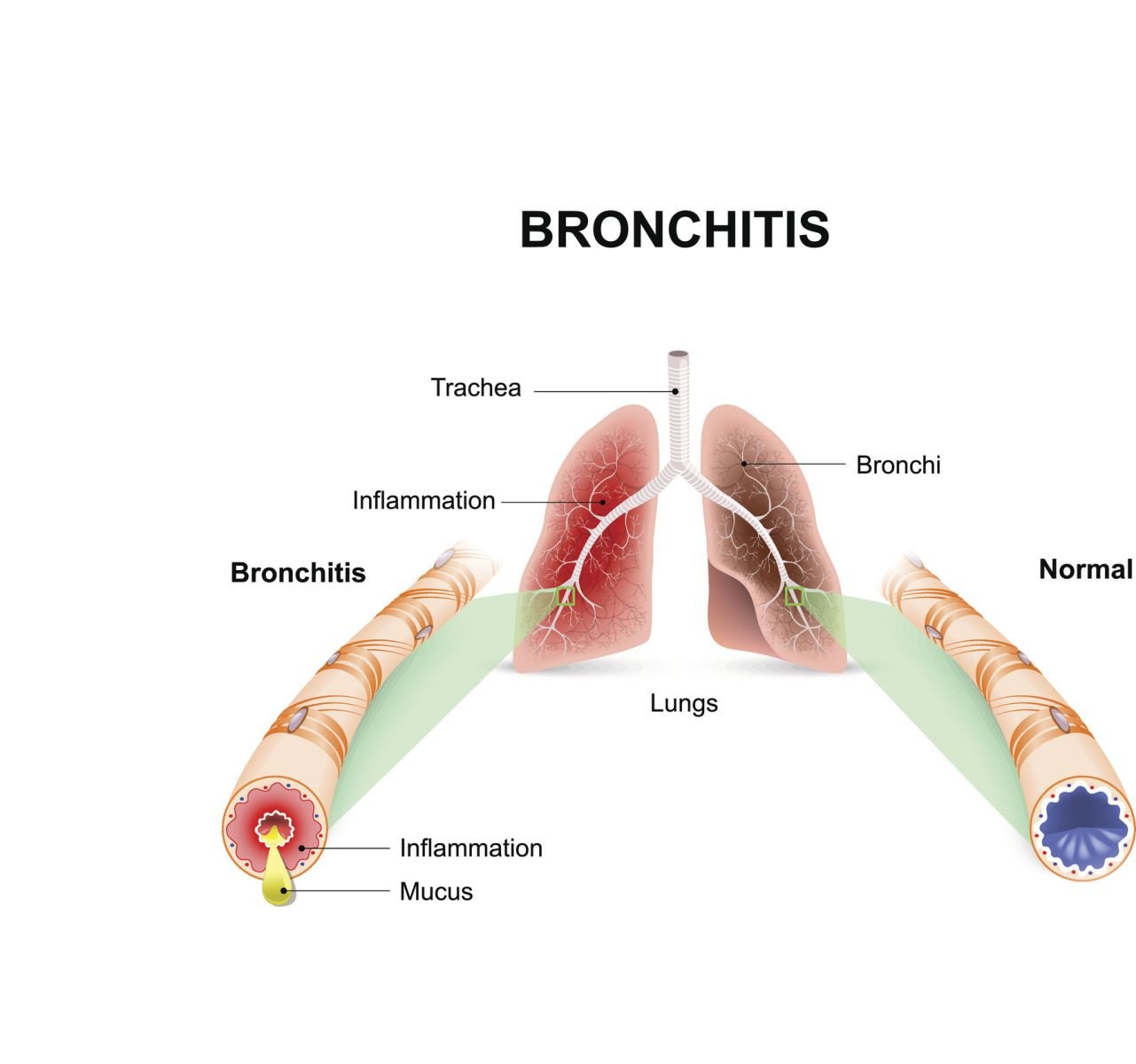 bronchitis