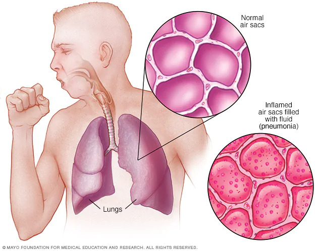 pneumonia and lungs