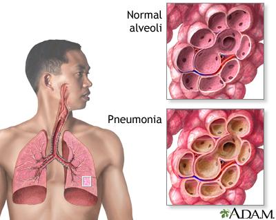 what is pneumonia